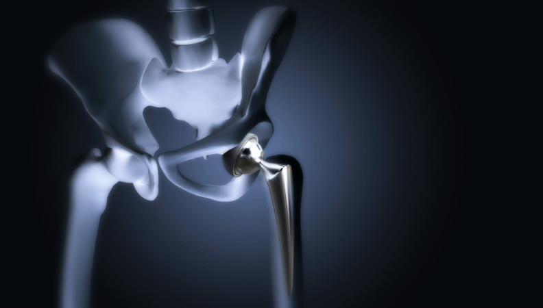 Hemi Hip Replacement Surgery