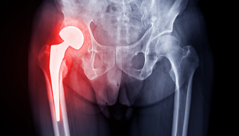 Total Hip Replacement Surgery