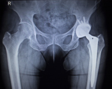 Cooled RF Hip Procedure